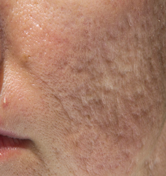 acne pic